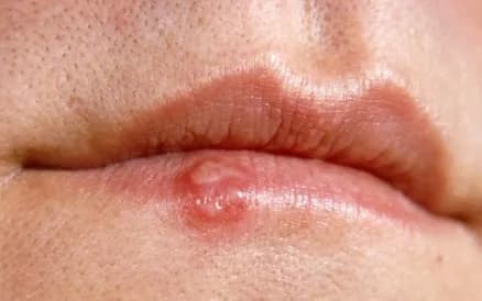 Close-up of a raised fluid-filled blister on the upper lip.
