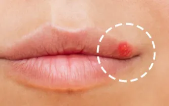 Close-up of a small raised red bump at the edge of the lip.
