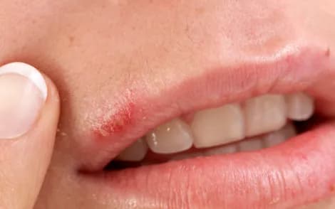 Close-up of a broken, raw patch at the corner of the mouth.