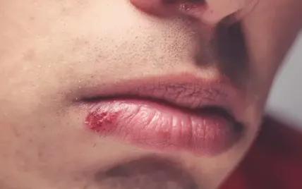 Close-up of a dark, dry crust on the lower lip.